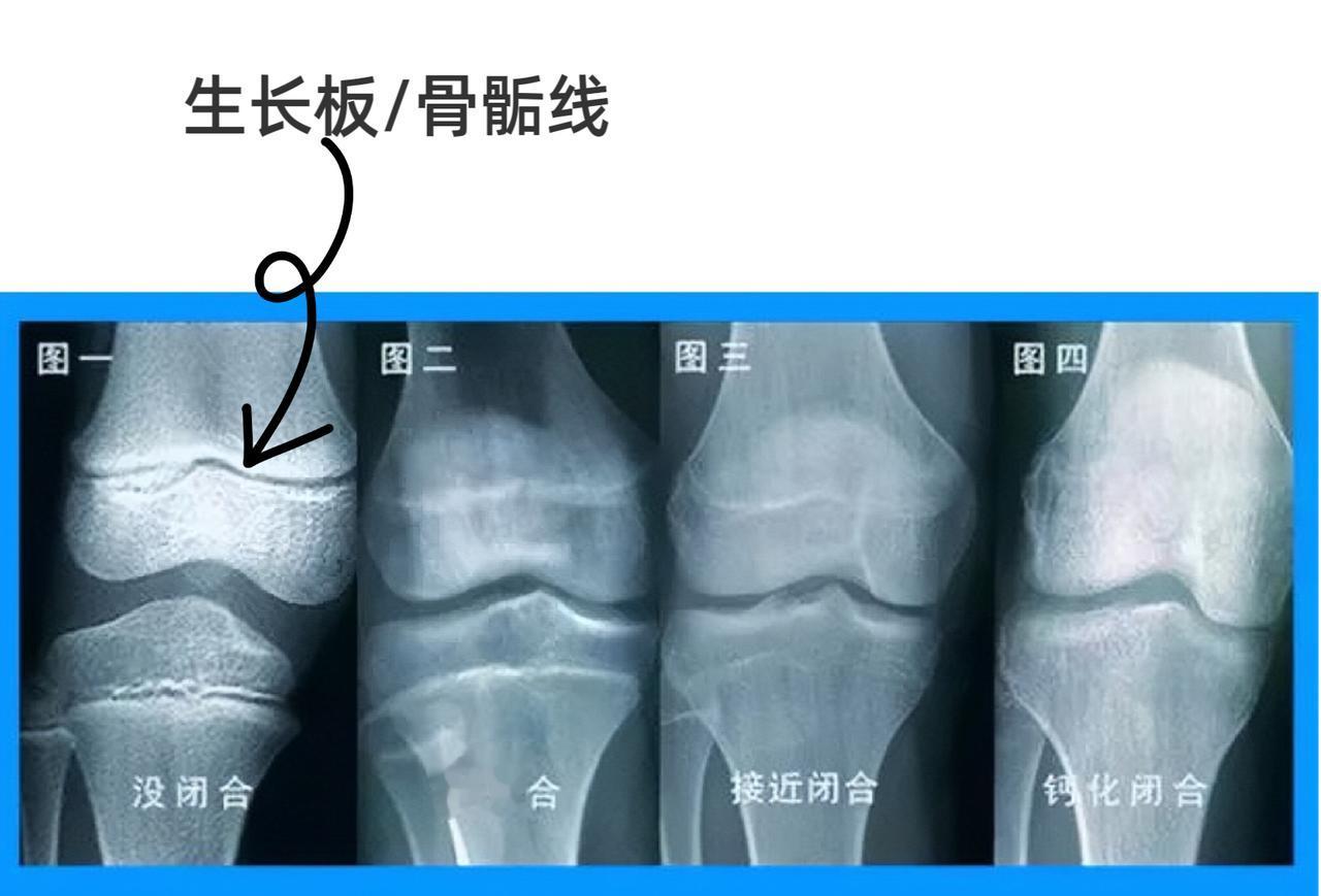 【长高科普】孩子长高，靠的是生长板！
 
生长板其实就是我们说的骨骺线，见下图，