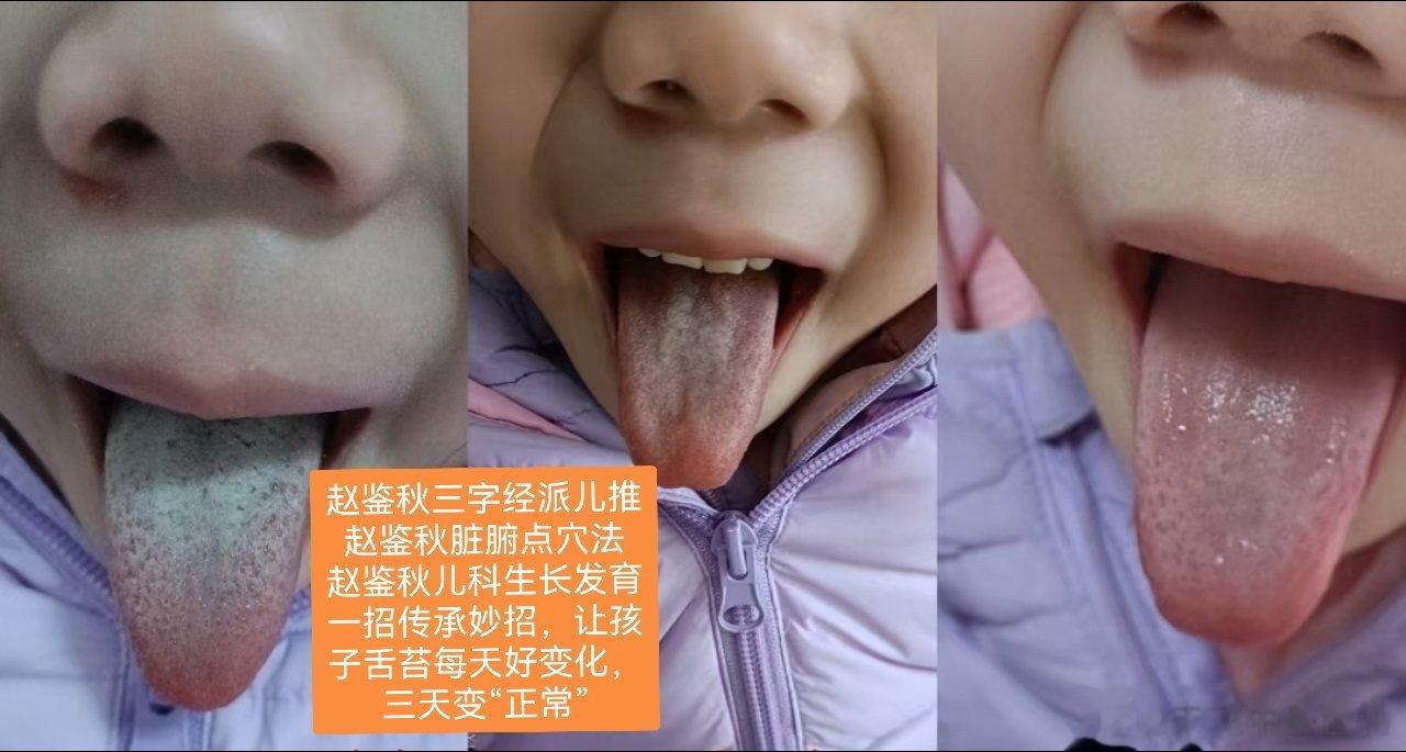 一个舌头三天的蜕变[得意]​如果你家宝宝有同款舌头👅，艾特我，教你简单实用方法