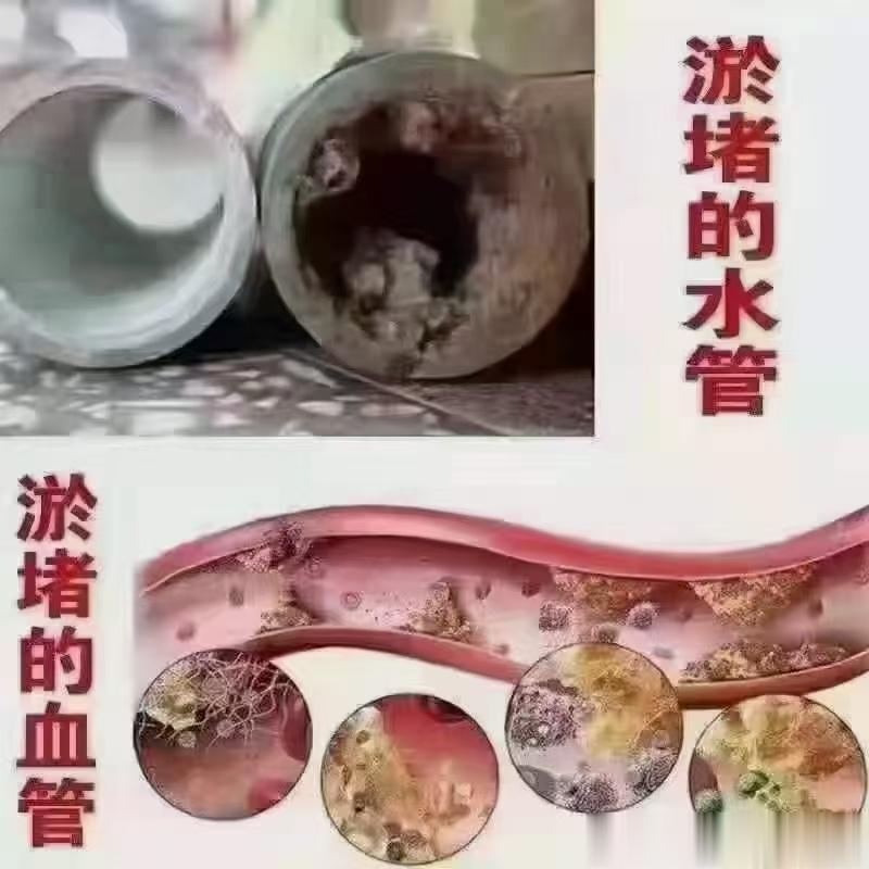 #心脑血管疾病# ⭕血管堵‭塞