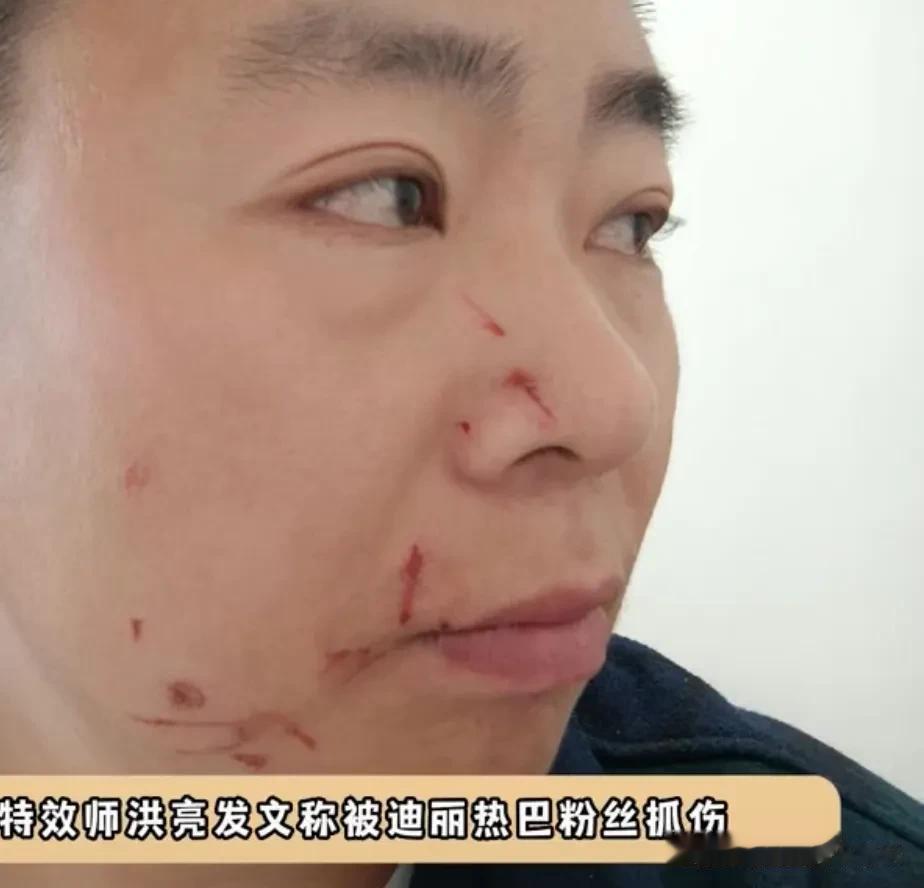 特效师洪亮被迪丽热巴粉丝抓伤[捂脸][捂脸][捂脸]我也觉得有些不妥，不应该做这