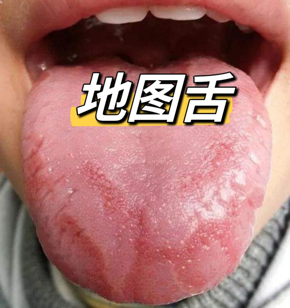 一看便知！孩子舌头变成这样，容易生病、长不高！
 
家长向我诉苦，差点流下了泪，