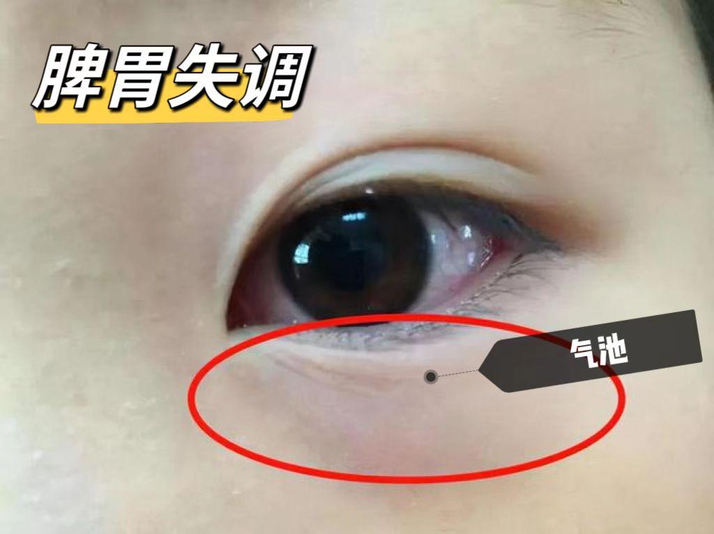 前天面诊了这么一个孩子，一眼判断孩子脾虚，家长们可以关注一下！
 
朵朵（化名）