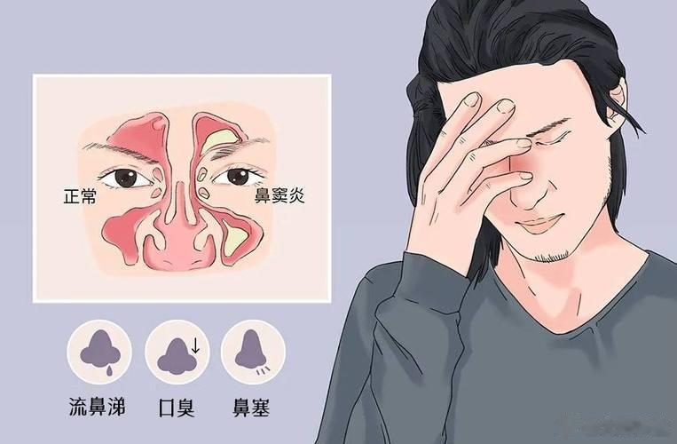 鼻炎，老中医是怎么治好的？西药不少都是抗过敏药、消炎药、激素药，并不能除根，所以