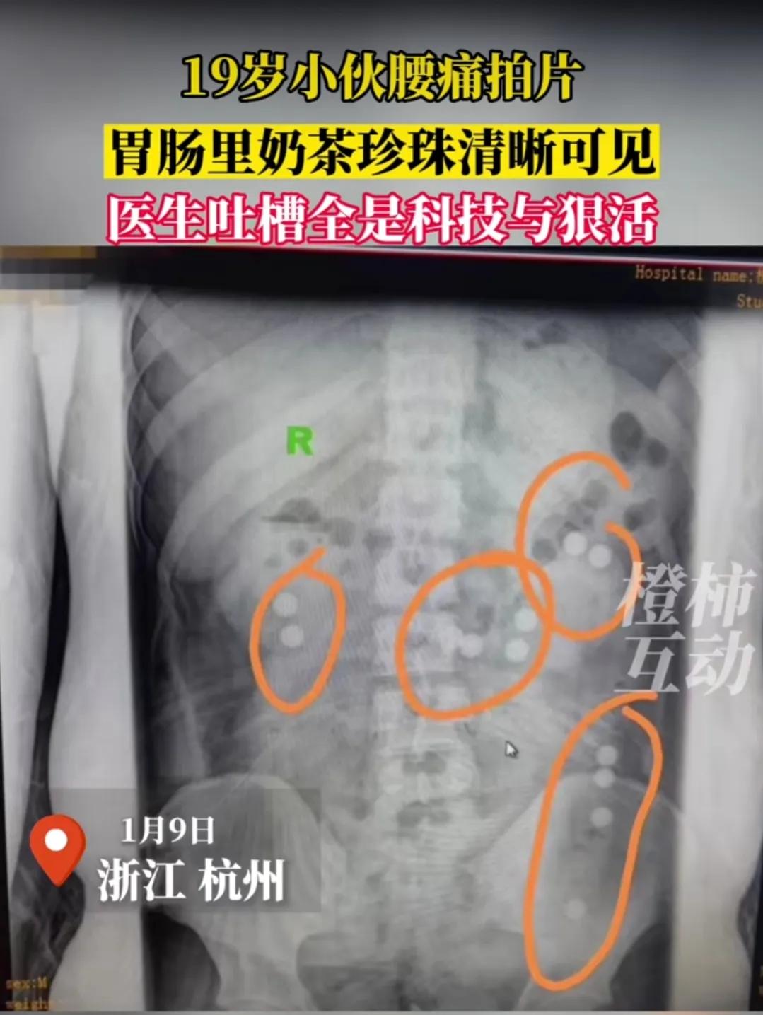 一名19岁小伙子腰疼去拍片，以为是感染新冠的后遗症，拍完片子后医生都震惊了，肠胃