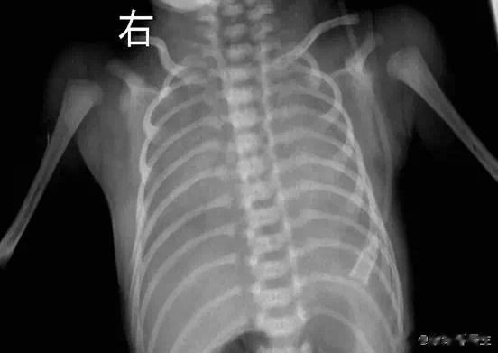 #新生儿成白肺医生跪地抢救##