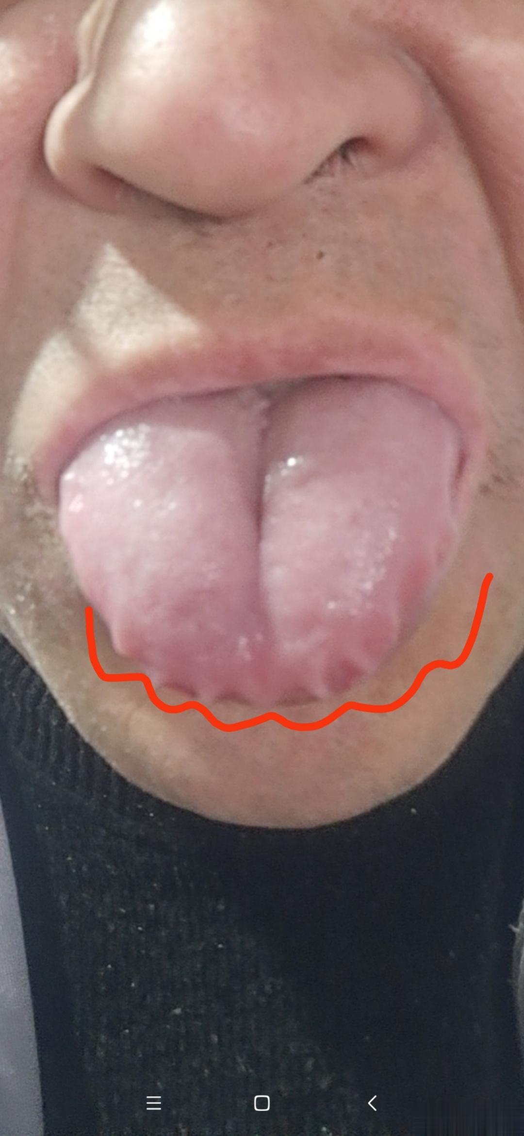 舌头胖大有齿痕，像啤酒瓶盖一样这是水湿内停，消化道也处于轻度水肿状态，舌头变胖大