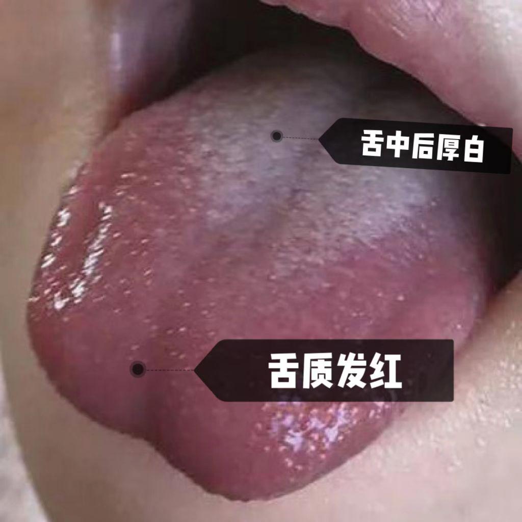 孩子吃得多，但舌苔厚，有可能是胃强脾弱！门诊上经常有家长问我，自家孩子食欲好，特