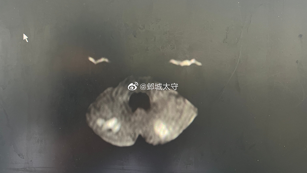 最近遇到好几个年龄不大的卒中患者，这个脑梗患者跟我年龄差不多，下午遇到个脑出血约