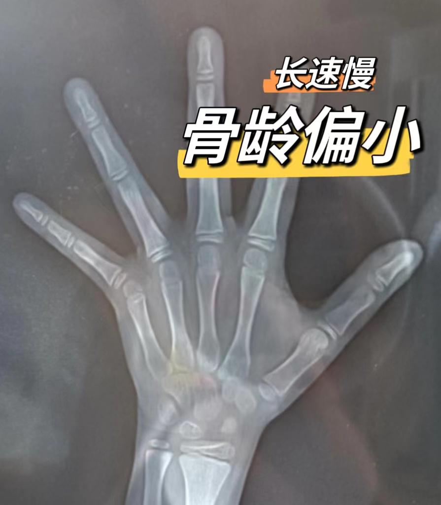 这是一个9岁男孩的骨龄片，骨龄在8.5岁左右。
 
▶孩子眼袋很重，5年过敏性鼻