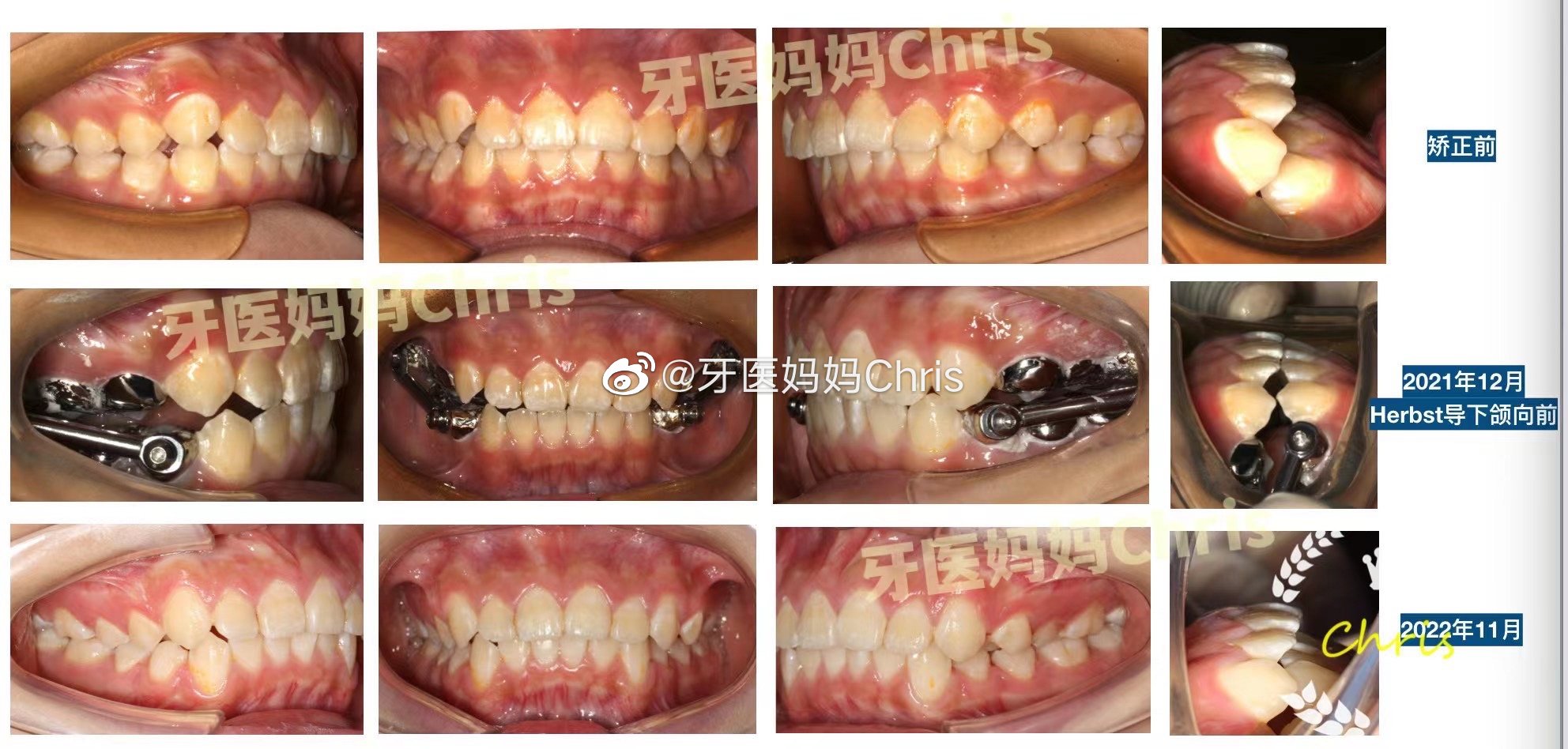  青少年下颌后缩矫正｜明确诊断