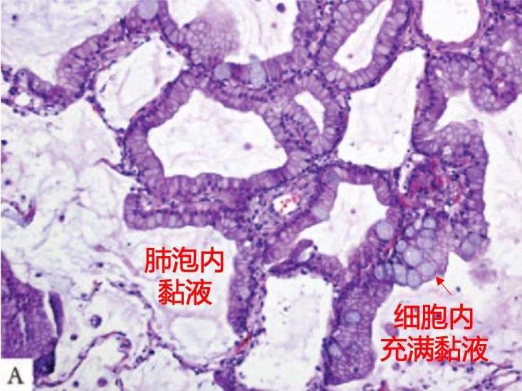 一个患者说差点被自己的痰淹死，他得了一种长得像肺炎的肺癌
最近病床上的一个患者，