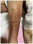 #用药指南# 抗过敏药物反而会诱发过敏？主诉：我岳父因身上发痒，在社区医院配了氯