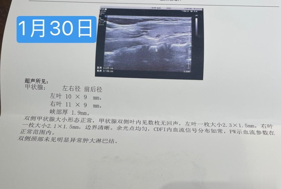 出差回来下午门诊。儿童甲状腺囊肿临床不多见，然一外地9岁女孩双侧囊肿，今日复诊，