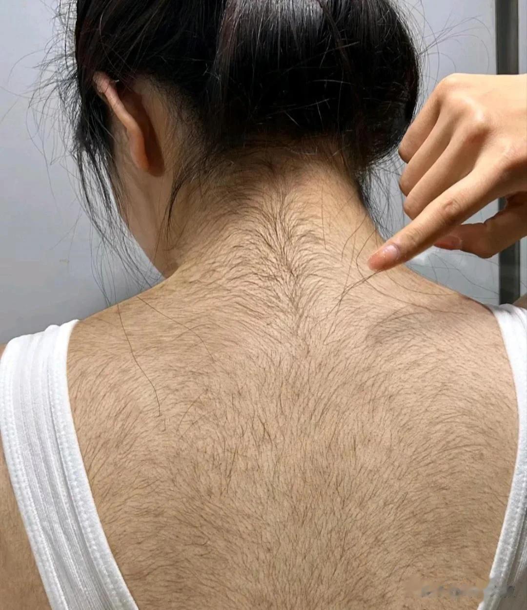 我有个哥们帮女朋友梳头，第一次看到她的后背[泣不成声]真是把我哥们给吓着了！这是
