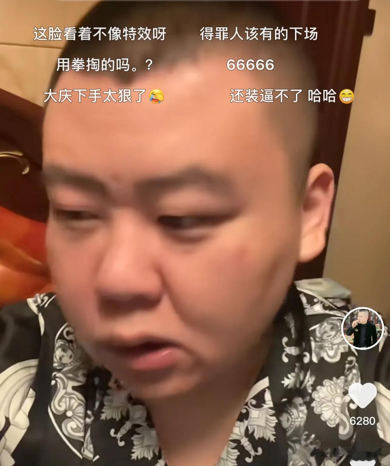 二驴徒弟元宝被三人殴打致伤！

元宝自述被仨男子打休克  拒绝150万赔偿直接送