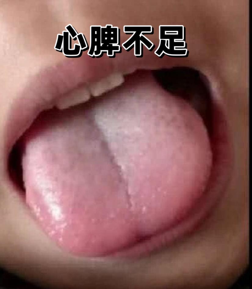 很多孩子舌头中间会出现一条凹陷，中医上，也叫脾胃气虚、中气不足！
 
仔细看舌尖