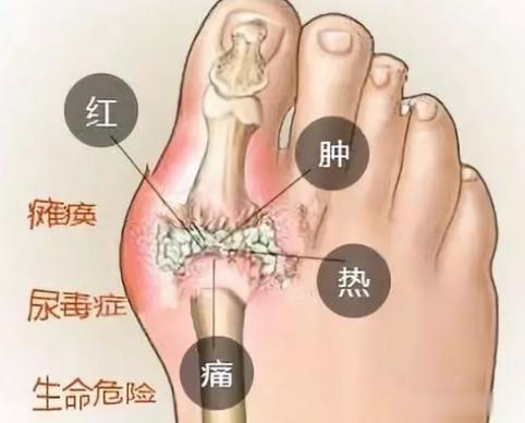 多年痛风，被金元神医朱丹溪一个方子搞定了[赞]福建草药师    痛风是时代病，现