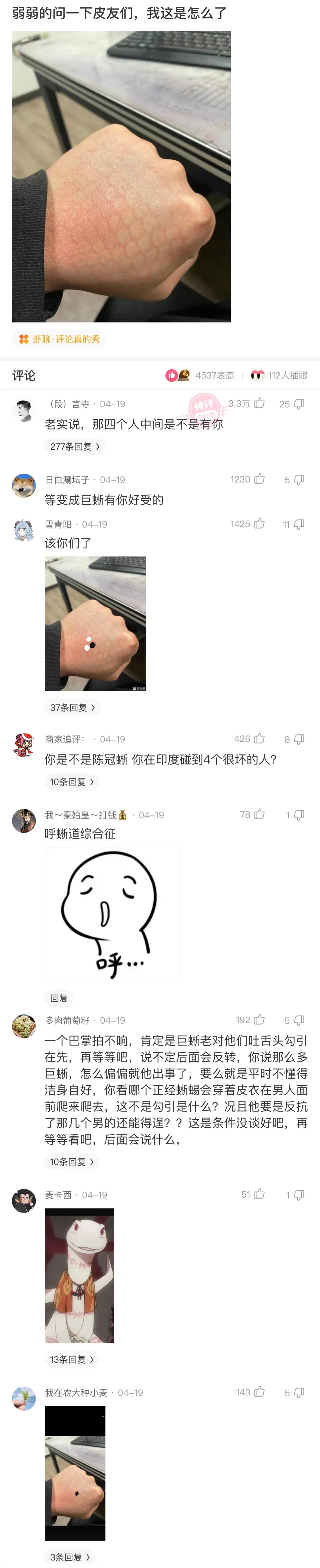 有个网友中午趴桌子上睡着了，然后起来一看，就发现自己的手不知道怎么了，看起来一个