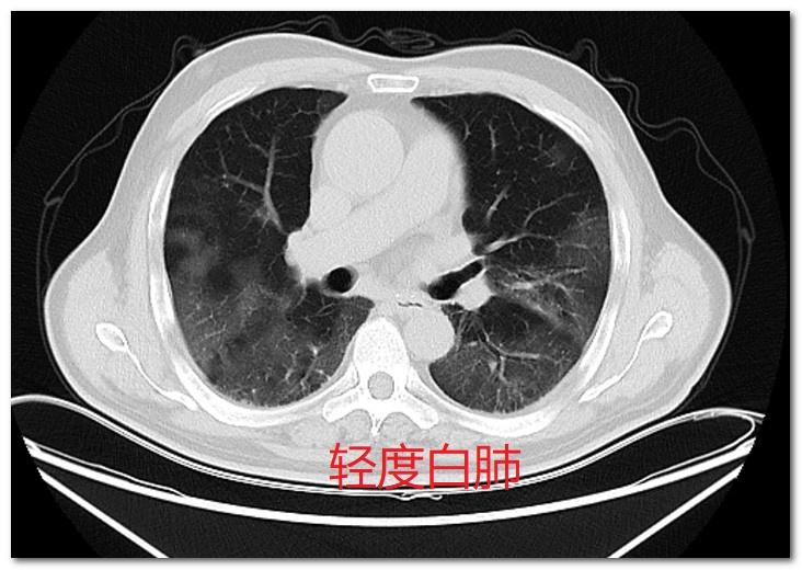 最近来门诊复诊新冠肺部后遗症的人员不少，都是前两个月新冠感染后肺部有炎症的，其中