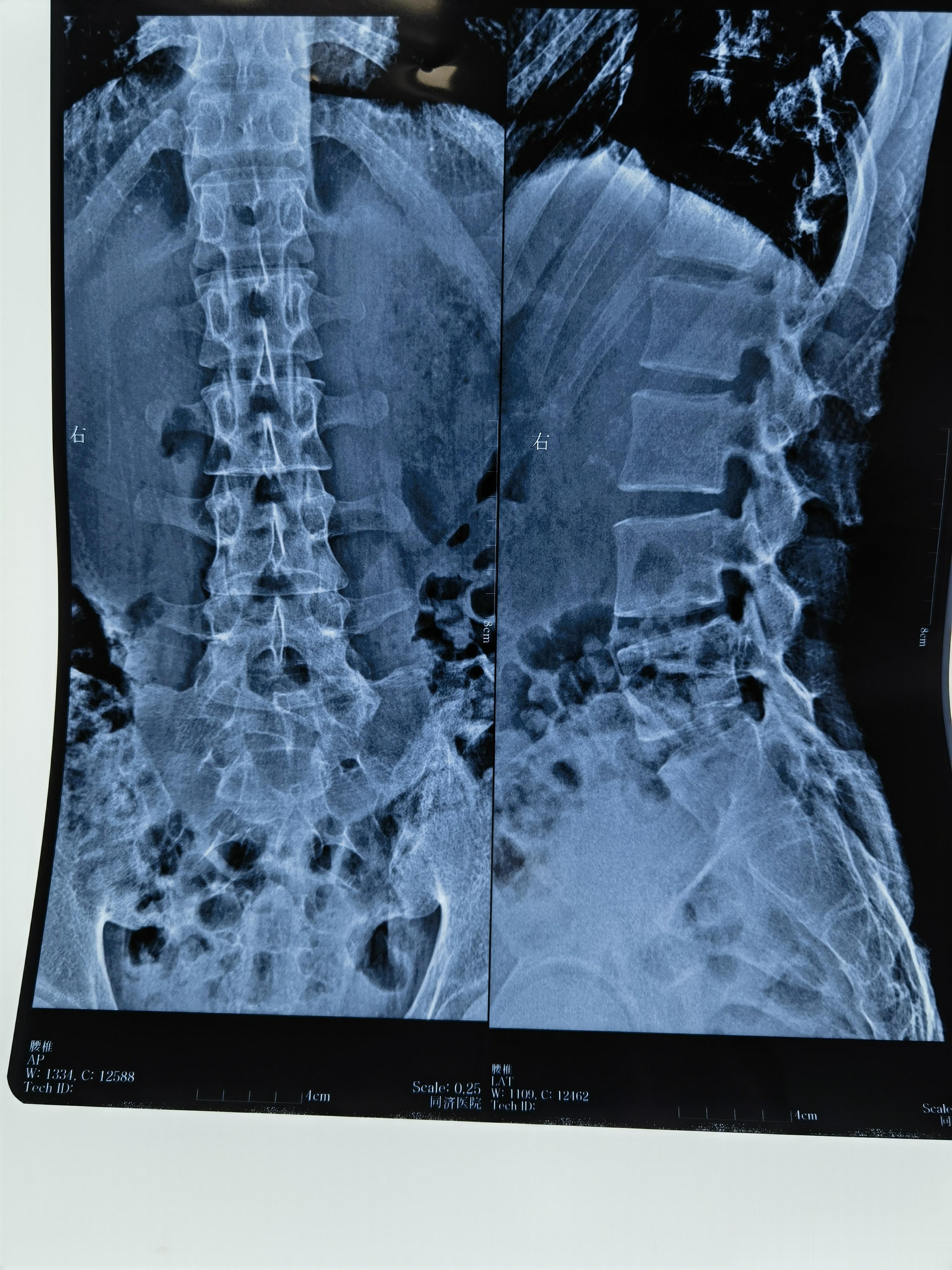  小伙子以前也偶有腰痛，阳了后