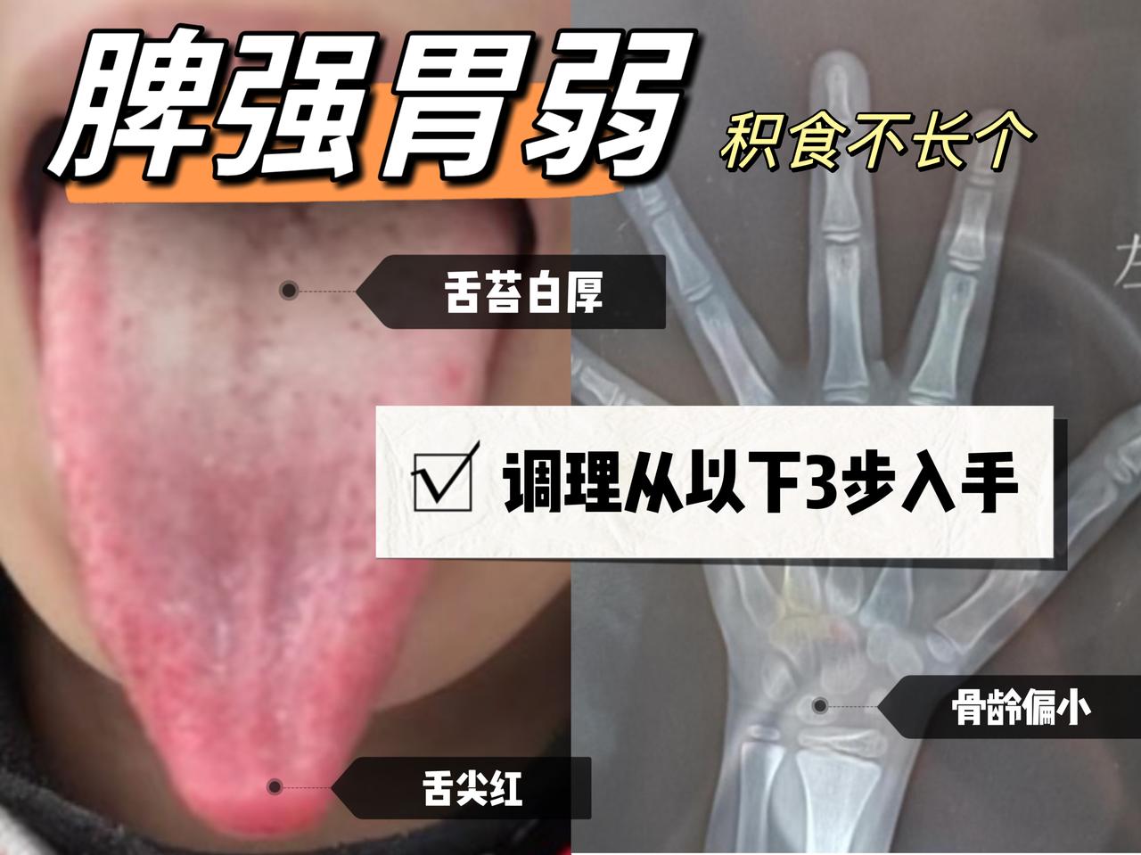 【典型案例分享】孩子胃强脾弱，脾气大，积食长得慢，调理从3方面入手。
 
您家孩