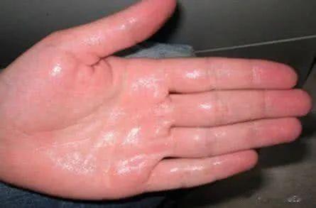 两味中药，3次治愈汗手汗脚[赞]在你周围或你自己碰到过这样的朋友，他她一年四季都