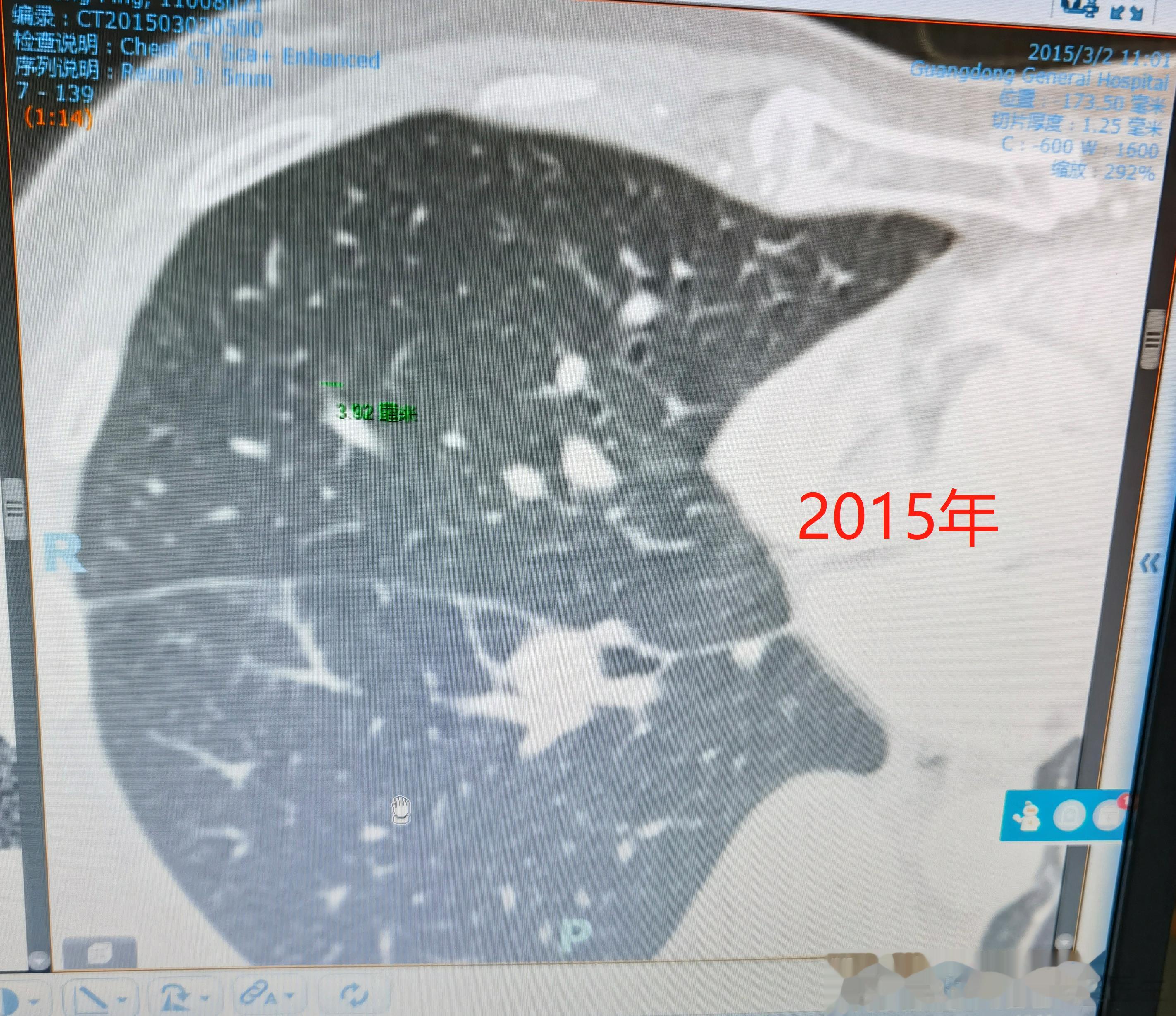 少见但经典！一个肺结节2015年到现在，慢慢长大的过程......这位患者朋友原