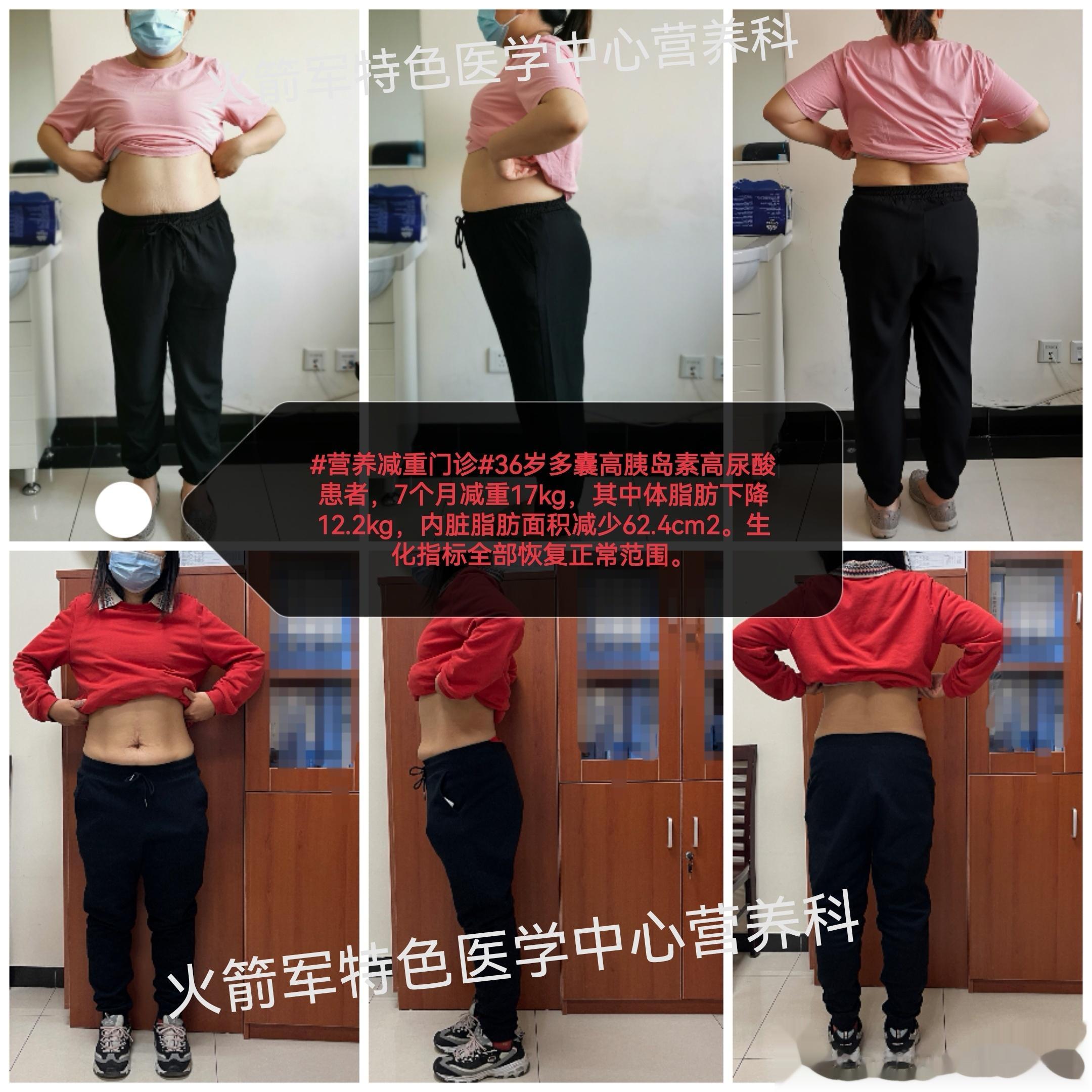 #医学营养减重门诊##2023活的更好##家庭健康守护计划# 36岁多囊高尿酸高
