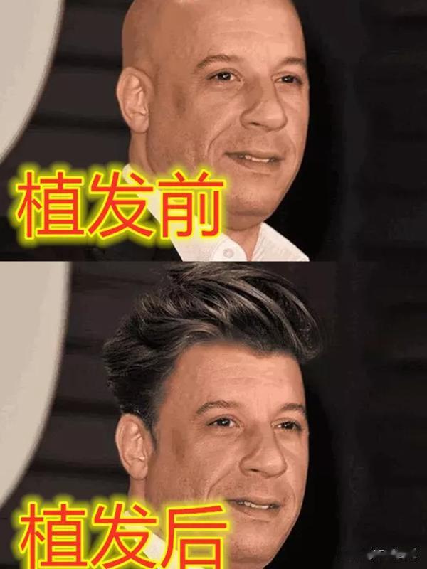 明星植发前VS植发后，强森变大
