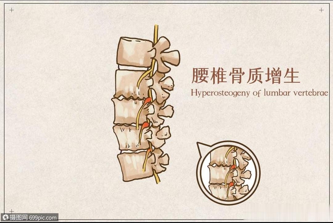 治愈【民间秘方】骨质增生验方，2付治好，一直未犯【配方】：血竭 36 克，白花蛇