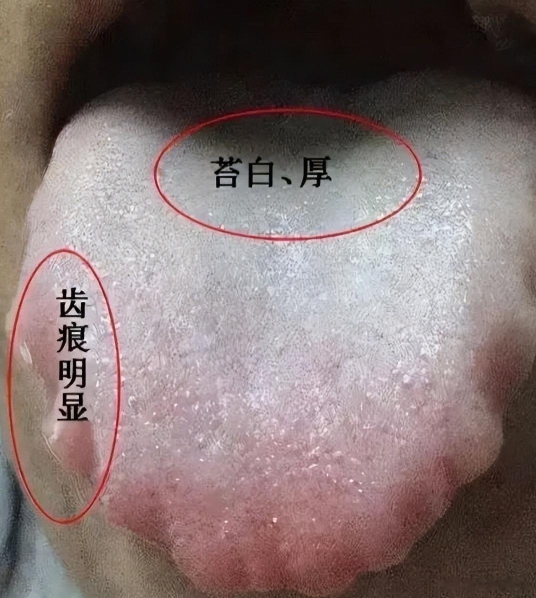 有人问我，湿气重，不能吃补药吗？湿气重，舌苔白腻，就不能纯补。如果需要吃补药，可