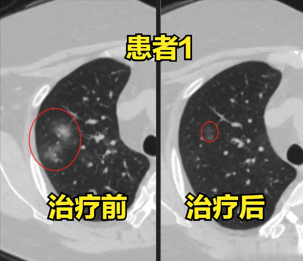 #我的防护手册# 为中医治疗新
