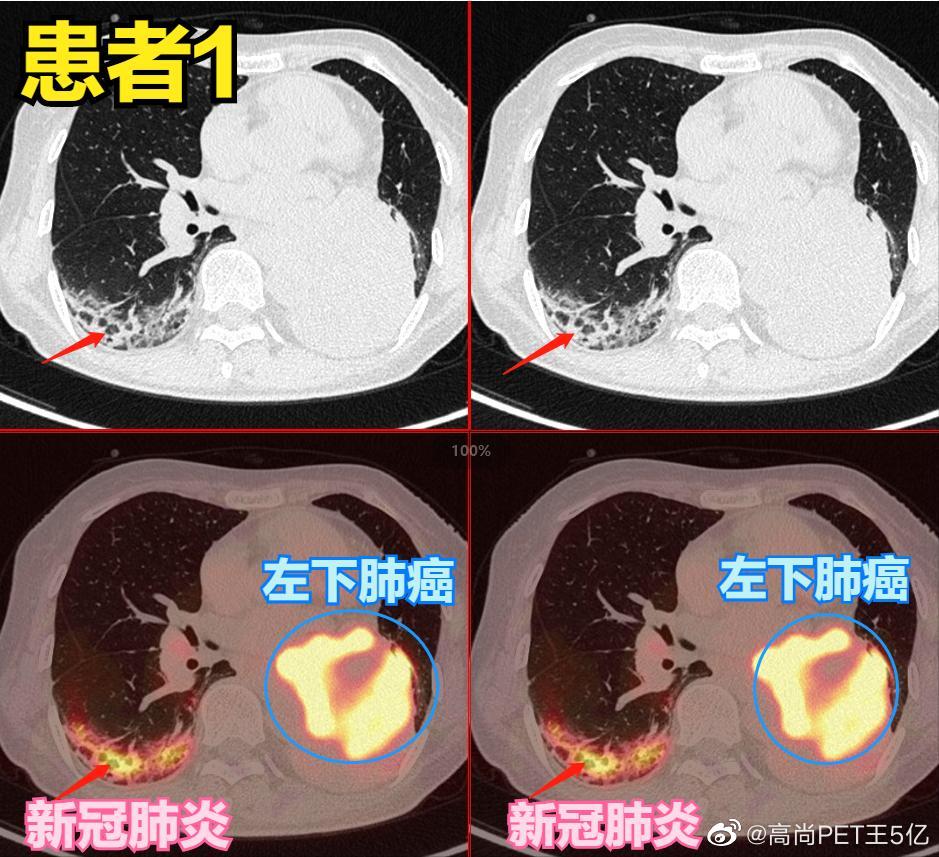 新冠病毒感染肺炎究竟有多大的破