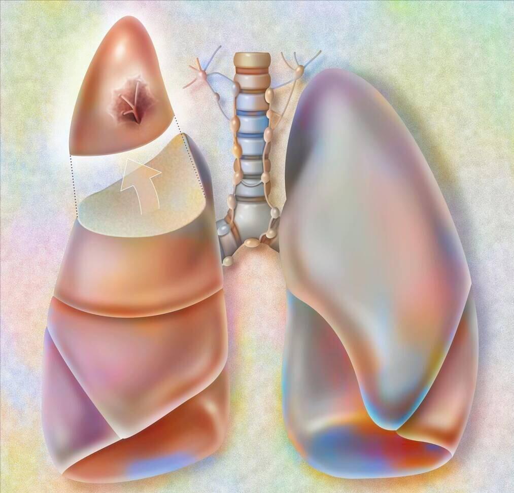 为什么总有这样的人，明明是肺癌早期，却因为吸烟做不了手术
病床上住着一个病人，因