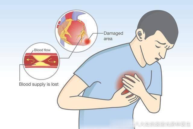 【突发心梗黄金4分钟应该做哪些事】微博健康公开课# 心肌梗塞是突发可能性较高的疾