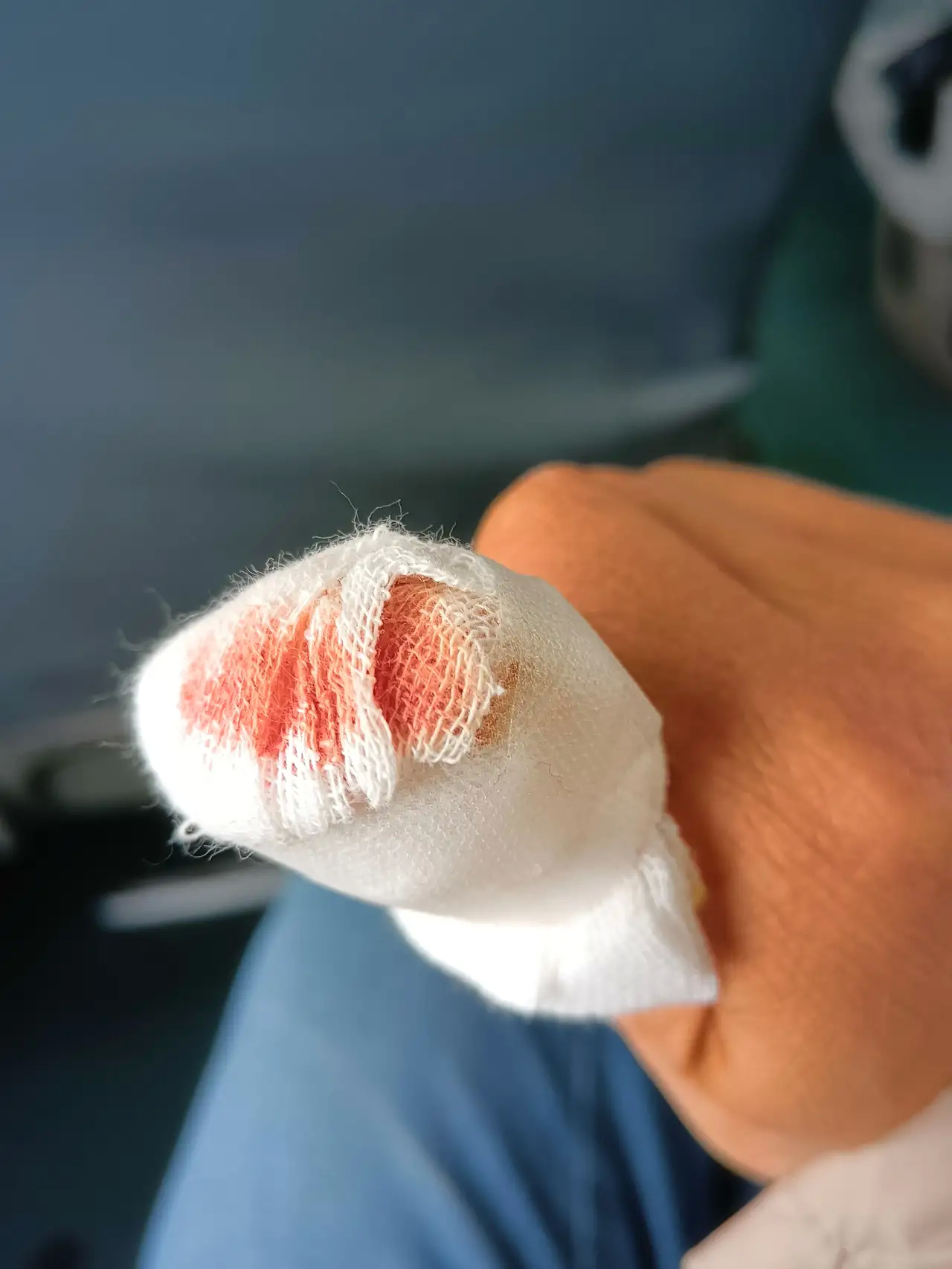 网友：医院真的是明晃晃地在抢钱啊！昨天早上在厨房刨黄瓜片时，由于没有用保护器，不