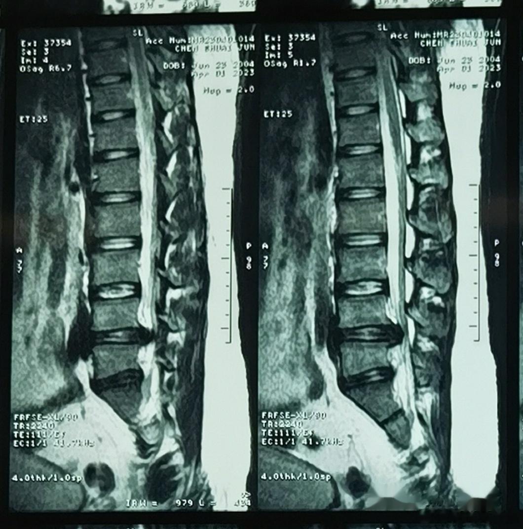可怜的小胖孩子，一个喷嚏把自己打废了。椎间盘突出这么多，18岁大男孩，疼的哭😭