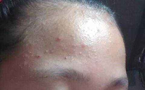 11岁半女孩来例假后，长速变慢，额头经常起痘痘，长期便秘，初诊时身高才146cm