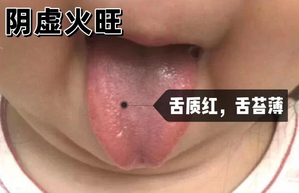 孩子脾气大、喜欢喝冷饮、大便干燥可能是阴虚火旺！看看你家孩子还有没有下列表现。
