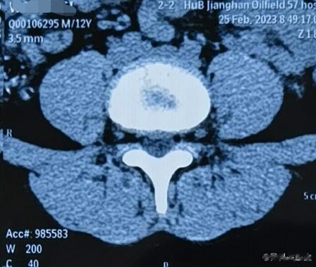 12岁的小学生都腰椎间盘突出了。久坐，缺乏锻炼。。。唉  ​​​