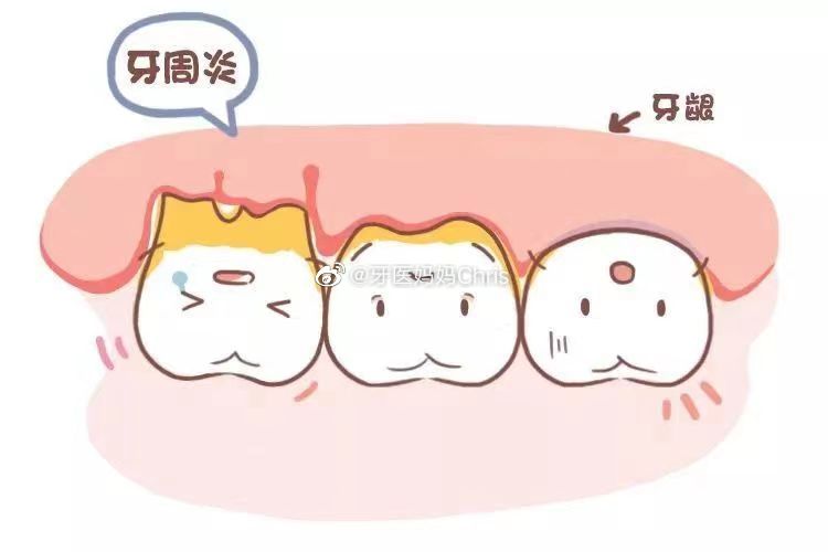 #牙周炎#怎么办？ 🌟为什么会得牙周炎？ 牙齿和牙槽骨之间存在一个狭窄的空间，