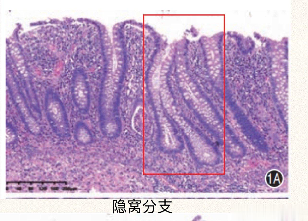溃疡性结肠炎，如何防止复发？这是溃结病人最常问的问题。先说说溃结为什么会复发？主
