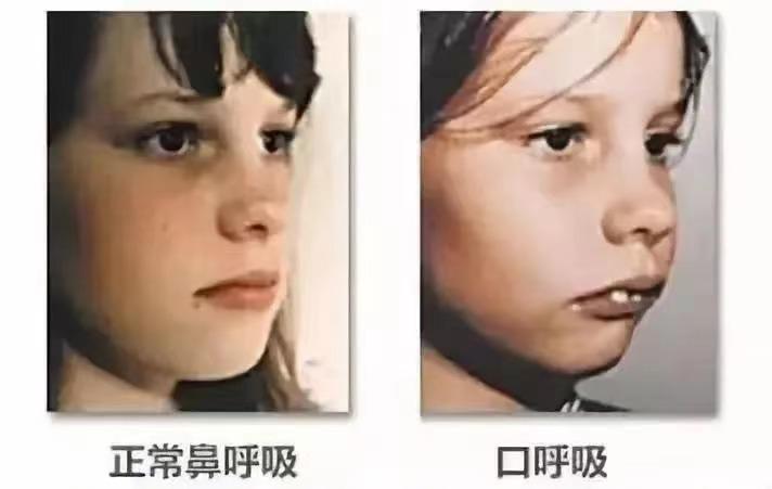 孩子张嘴呼吸，睡觉打呼，很多家长反映孩子越来越丑！
 
大家应该都知道“腺样体面