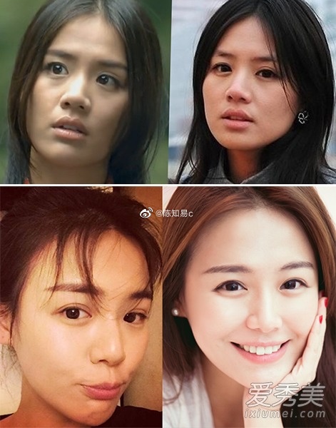现在明星基本都在借助医美手段维持颜值，即便是我前两天刚讲过刘亦菲也不例外，骨相好