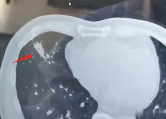 结节、肿块、占位，究竟哪个才是肿瘤？其实这几个词都是影像的诊断，并不是病理结果。