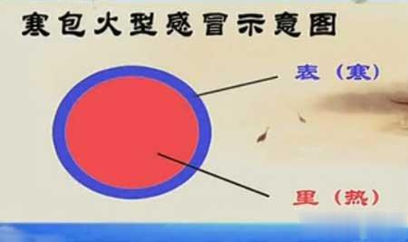 “寒包火”感冒，是最常见的类型寒包火，就是外寒内热。外寒表现为浑身怕冷，发热，不