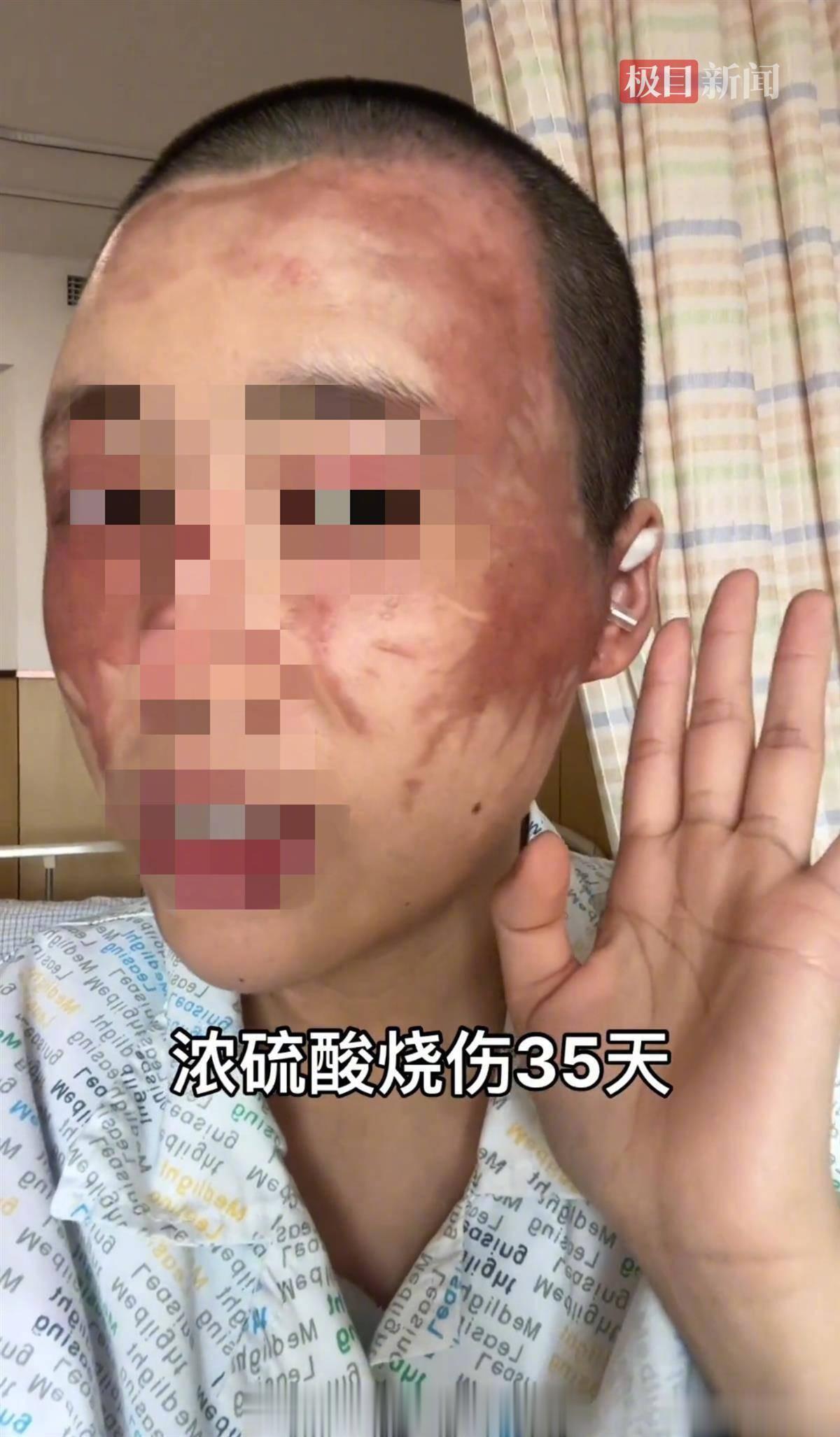 【#被丈夫泼硫酸毁容女子发声#：因不想生二胎被威胁 曾说不生就砍死我】张女士介绍