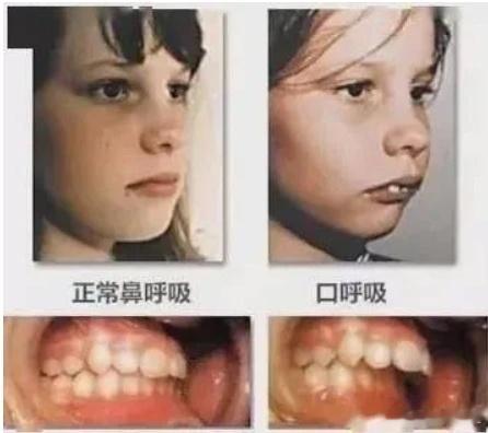   【什么是腺样体面容？】在我们的咽喉部有一组淋巴组织，叫腺样体。腺样体休肥大的