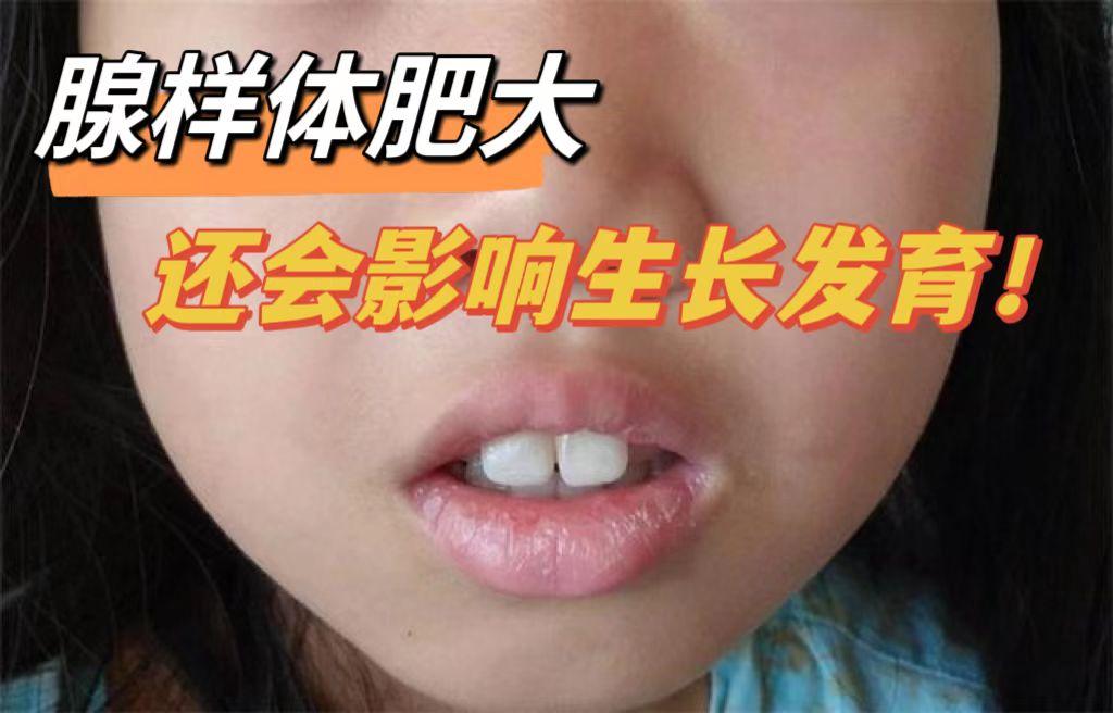 【腺样体肥大】睡觉打呼、张嘴、嘴巴变“突”，孩子慢慢变“丑”，手术后又复发，到底