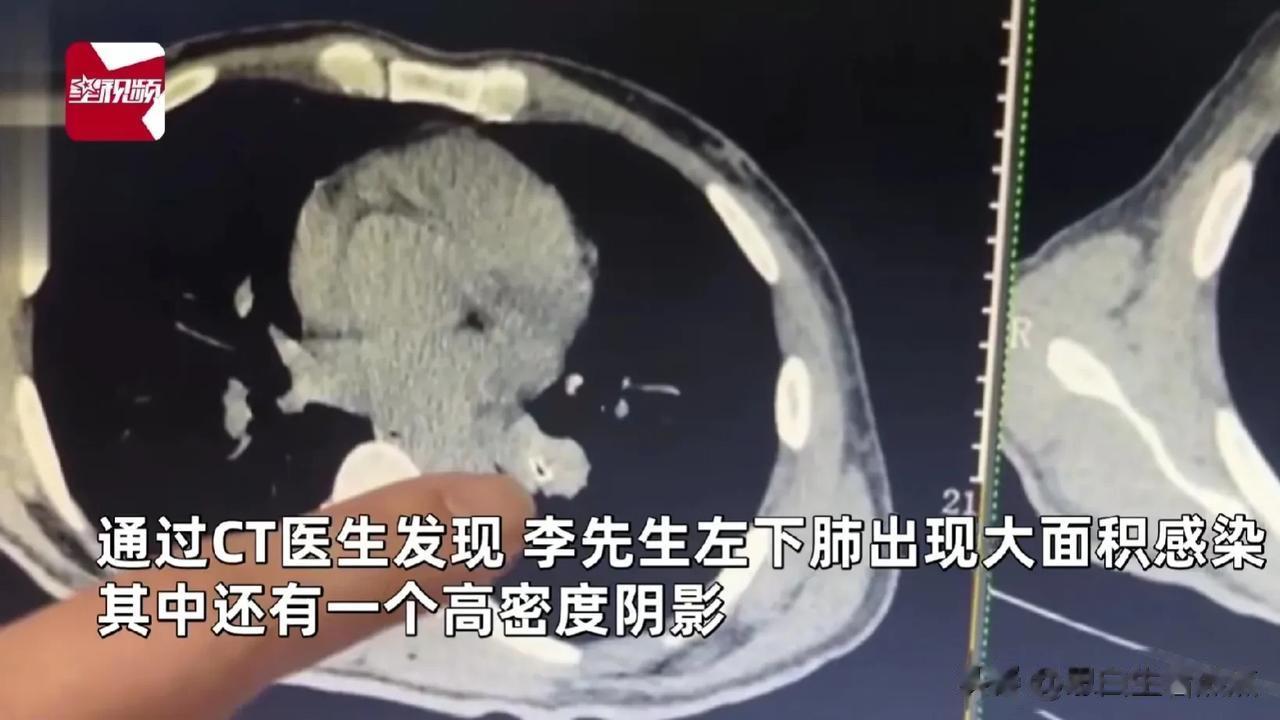 边吃小龙虾边听笑话，半年后被查出来癌前病变。
湖北武汉，一男子一次与朋友聚餐时点